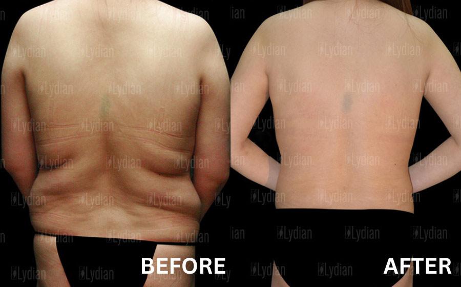 back liposuction korea