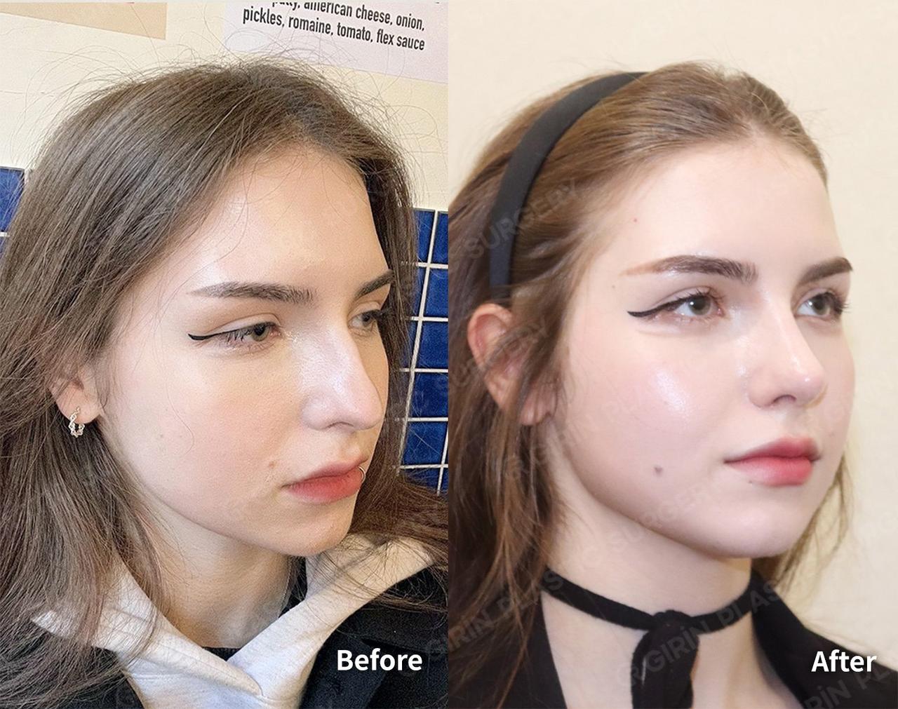 Before and After Rhinoplasty