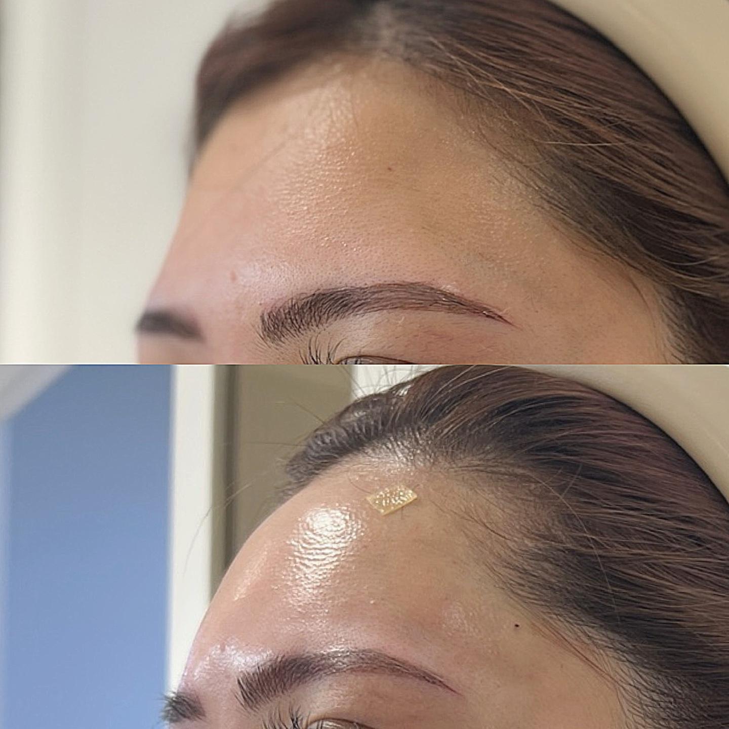 Forehead Filler