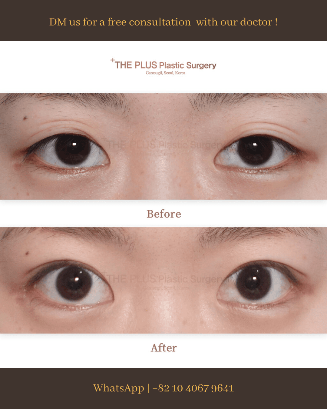 Revision Eye Surgery