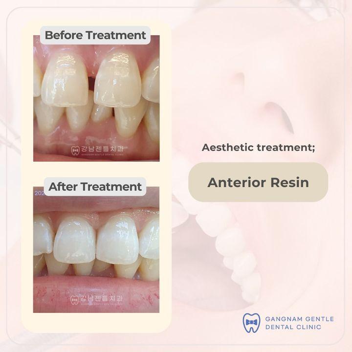 Anterior resin is a tooth-colored material that is used to repair or restore chipped, cracked, or decayed front teeth. It is a popular choice for dental restorations because it is strong, durable, and aesthetically pleasing. 🦷✨  Anterior resin restorations are performed in a single dental appointment. The dentist will first prepare the tooth by removing any decayed or damaged material. Then, they will apply the resin material to the tooth and shape it to match the surrounding teeth. The resin is then cured with a special light, and the restoration is complete.