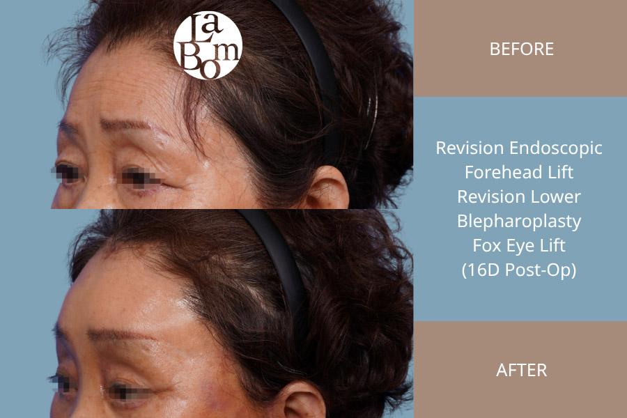 Before and After Endotine Lift