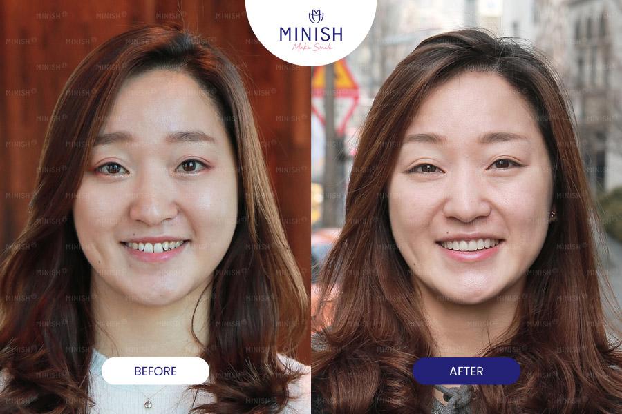 Before after