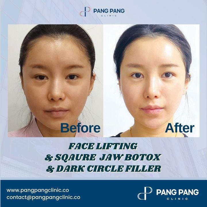 botox in korea