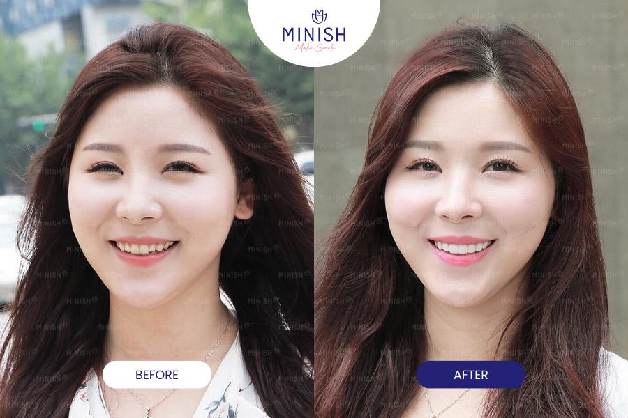 Before and After All-ceramic Veneers