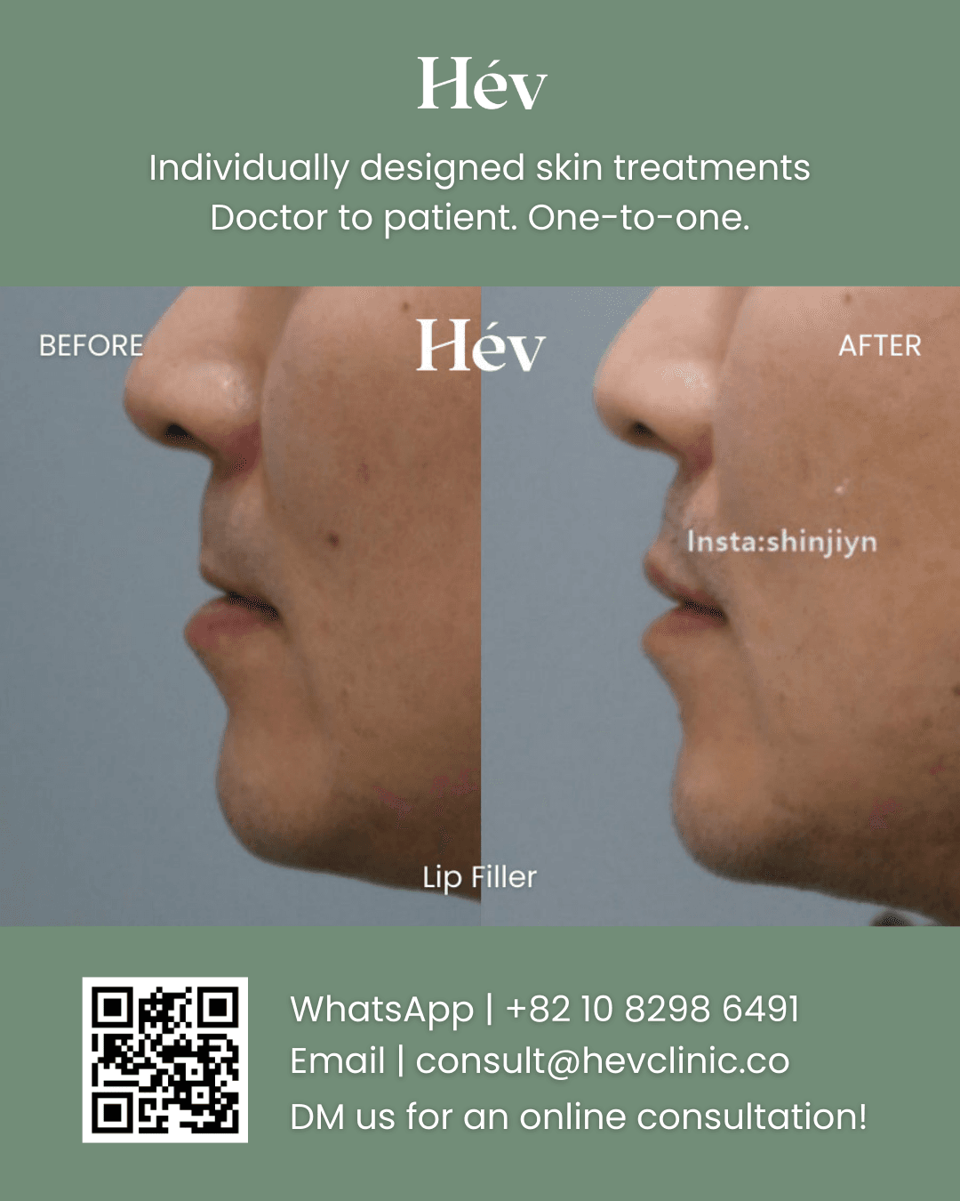 Lip Fillers