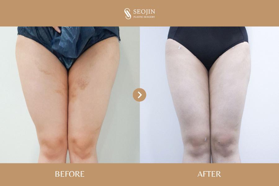 Vorher-Nachher-Bild der Seojin Plastic Surgery Clinic
