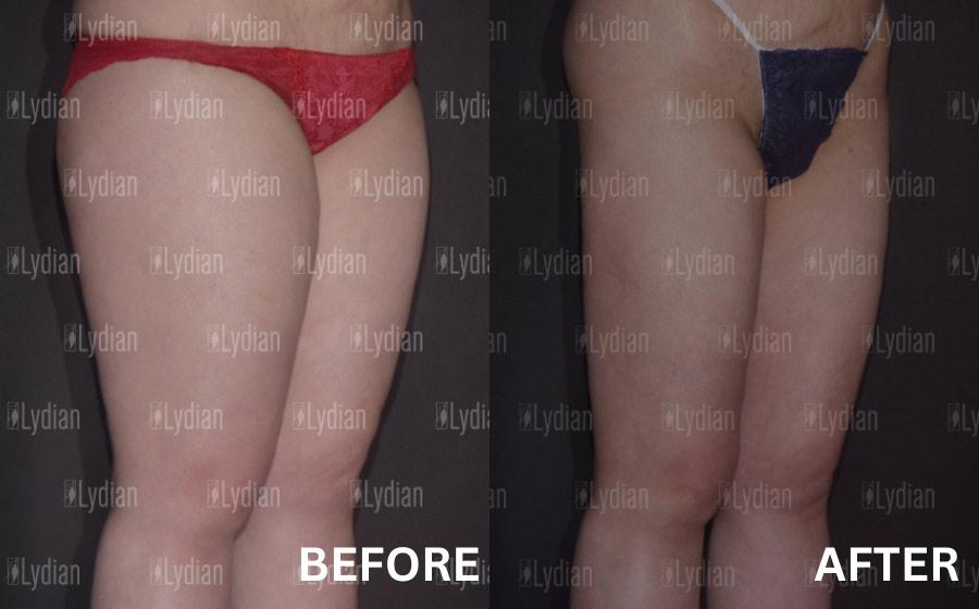 bulky quadriceps fat korea