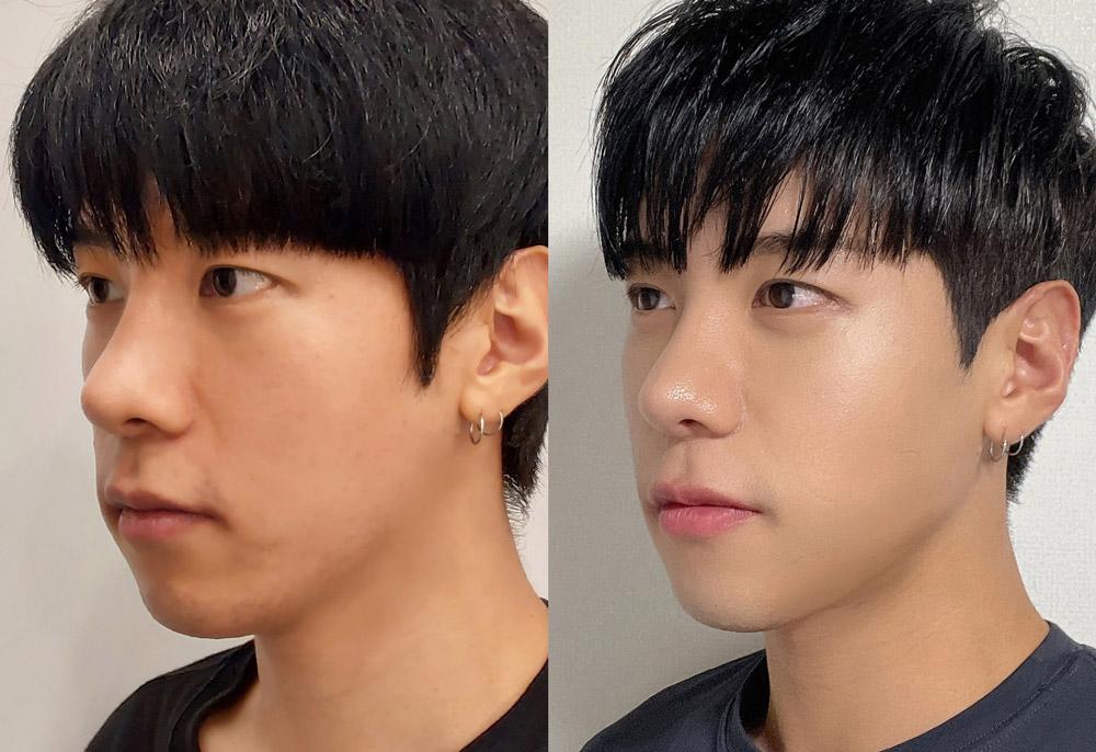 Before and After Face Thread Lift