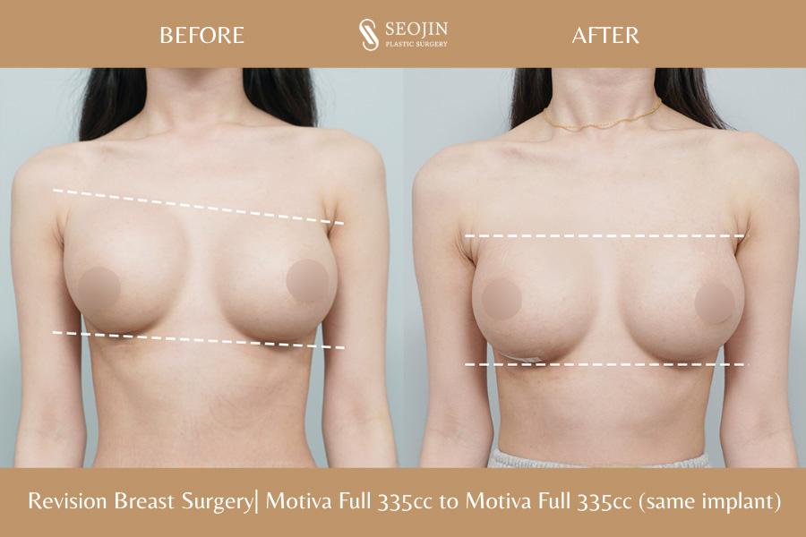 Seojin Plastic Surgery Clinic before and after image