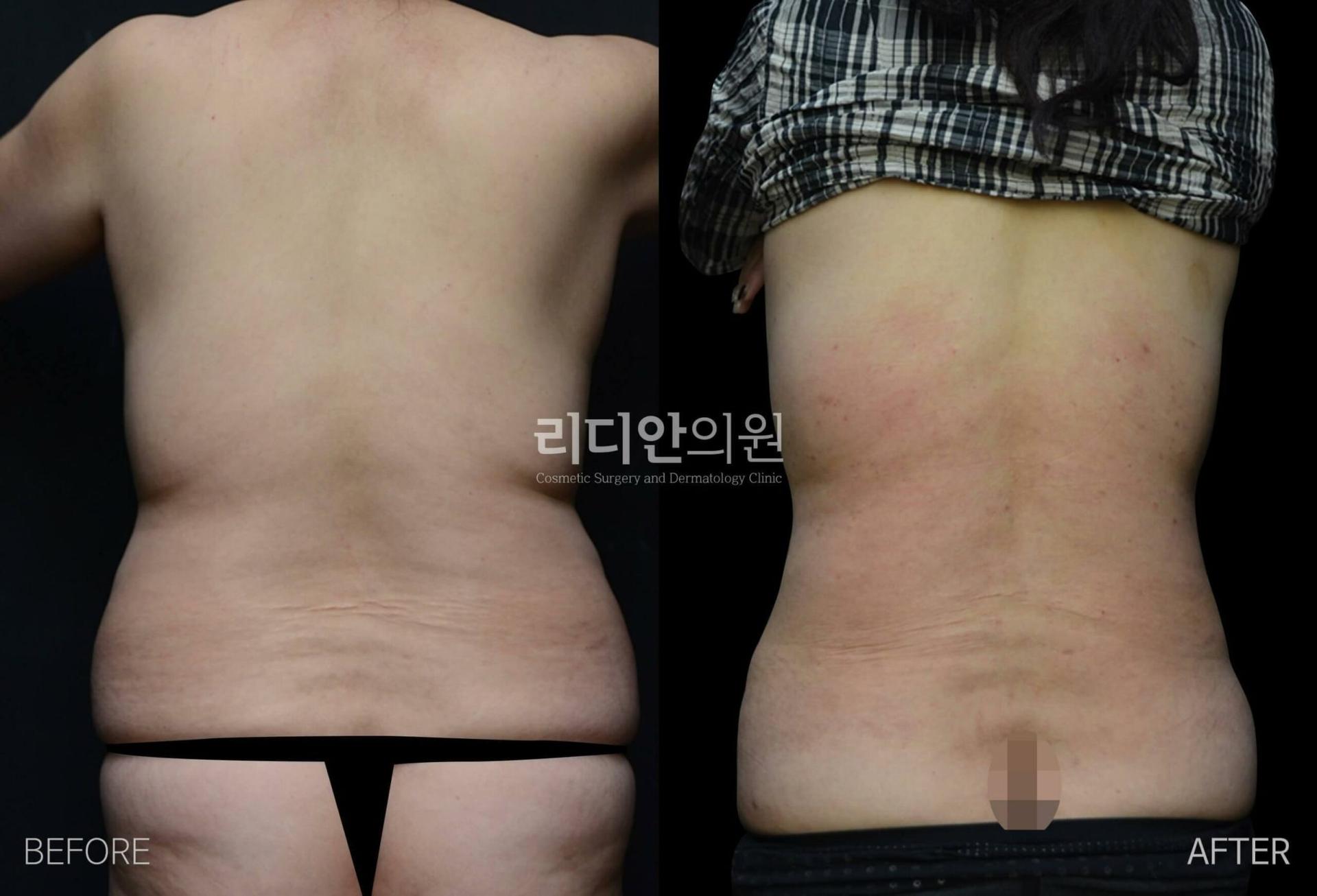 lydian-female-back-liposuction-02.jpg