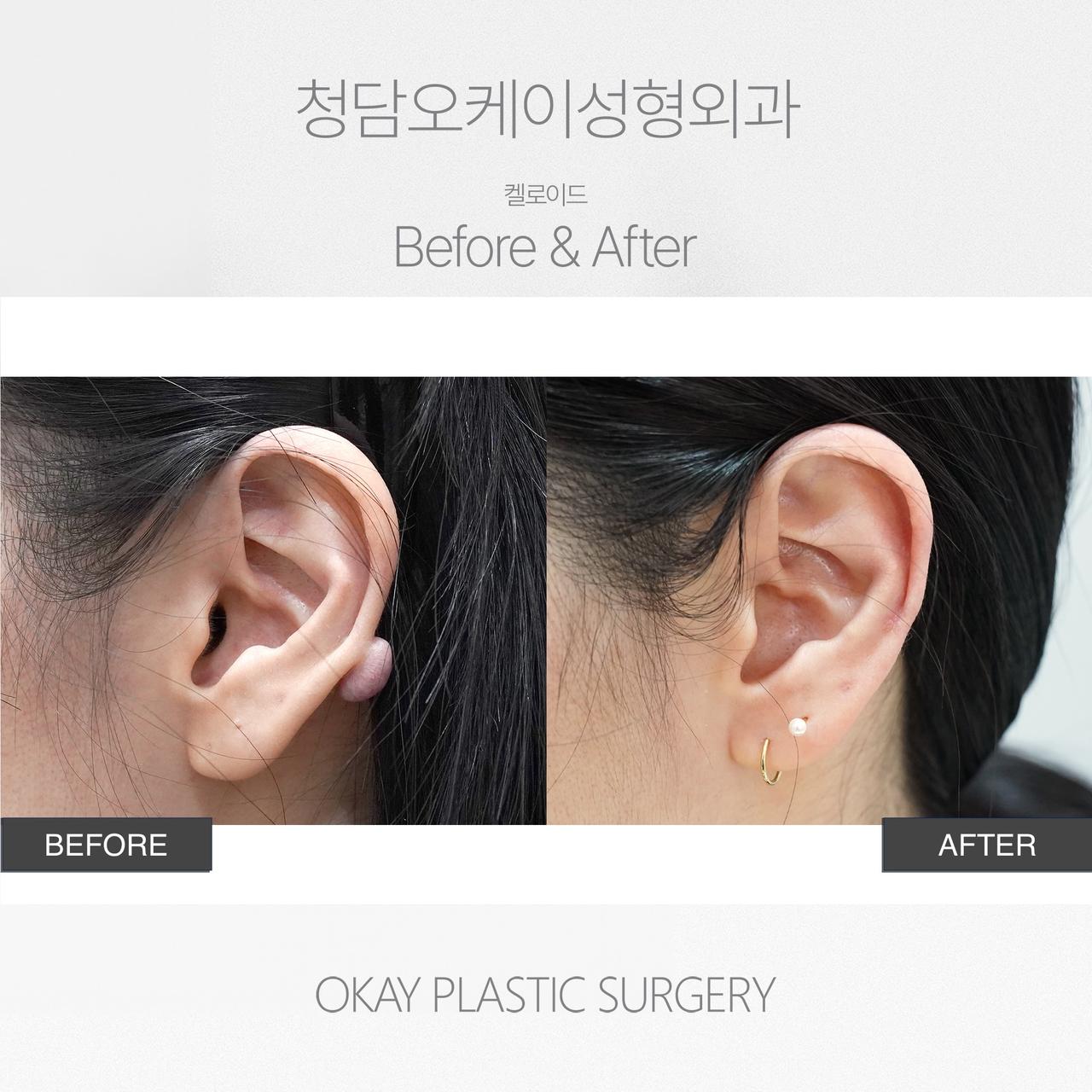 Before and After Keloid Removal