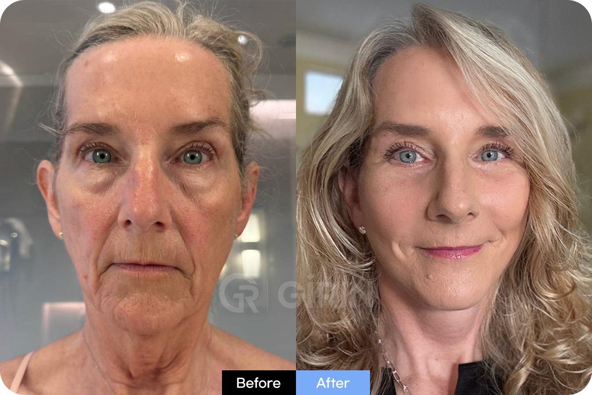 Before and After Face Lift