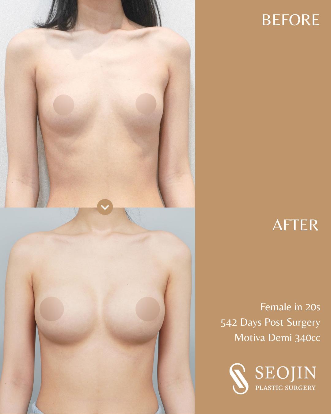 seojin-breast-implant-15