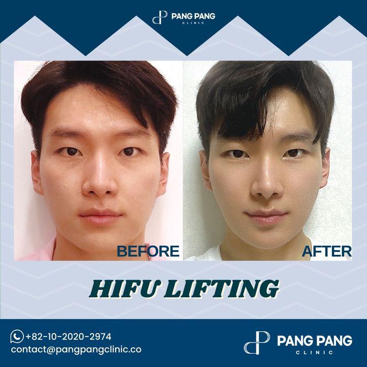 cost hifu laser korea