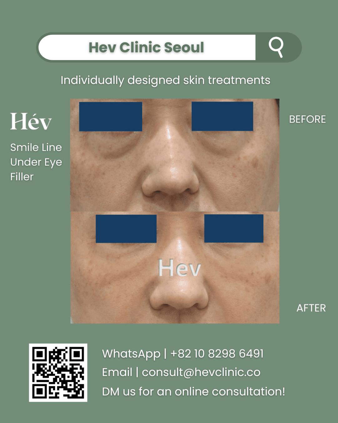 Smile Line Filler, Under Eye Filler, Dark Circle Injection