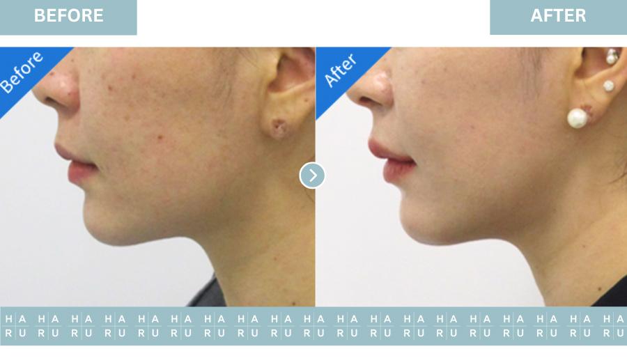 Before and After Bullhorn-Lip-Lift