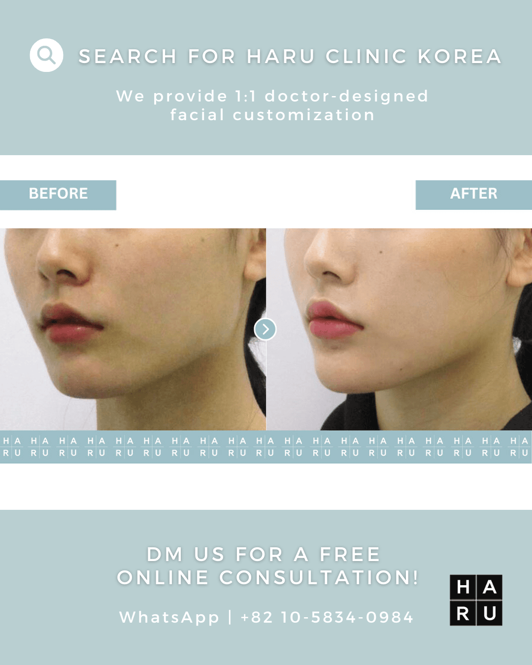 Chin Filler, Chin Botox