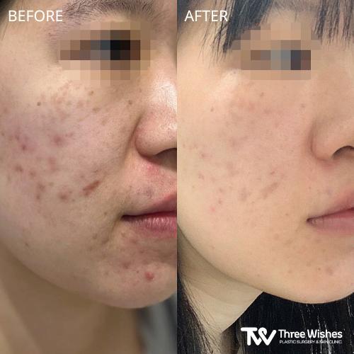 tw-acne-treatment3 