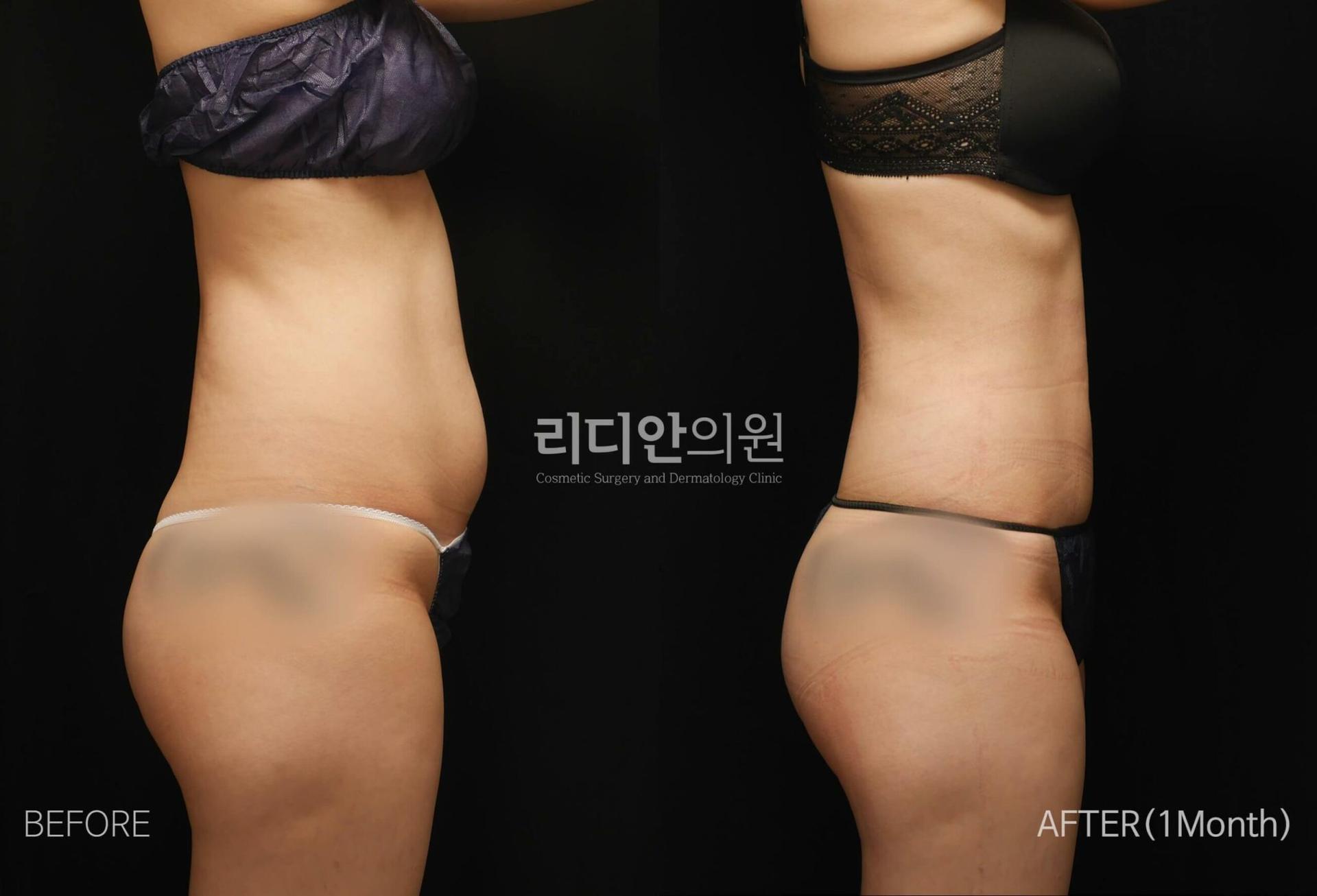 lydian-female-abdominal-liposuction-02.jpg