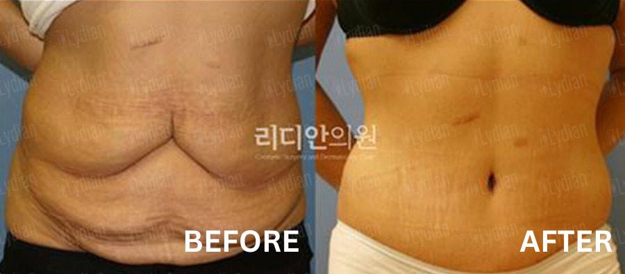 tummy tuck korea