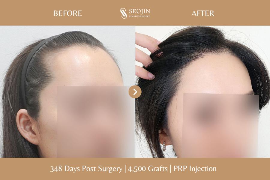 Before and After Hair Transplant