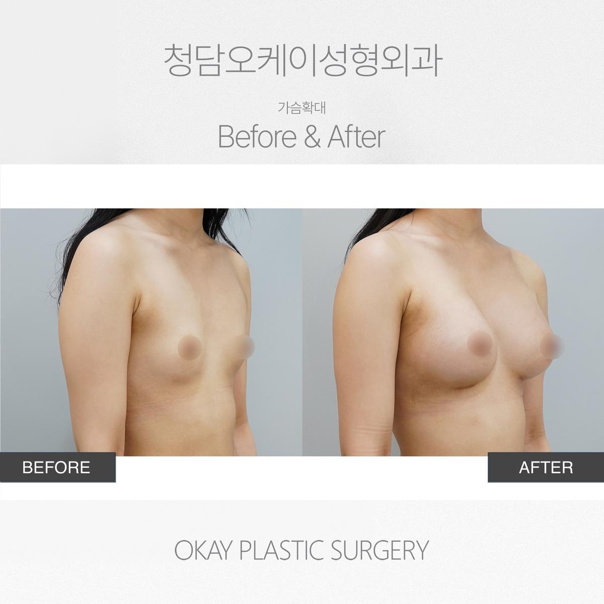 Before and After Breast Augmentation