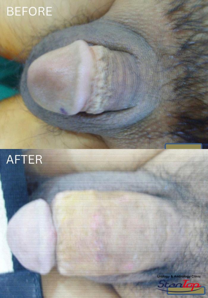 Before and After Glans Enlargement