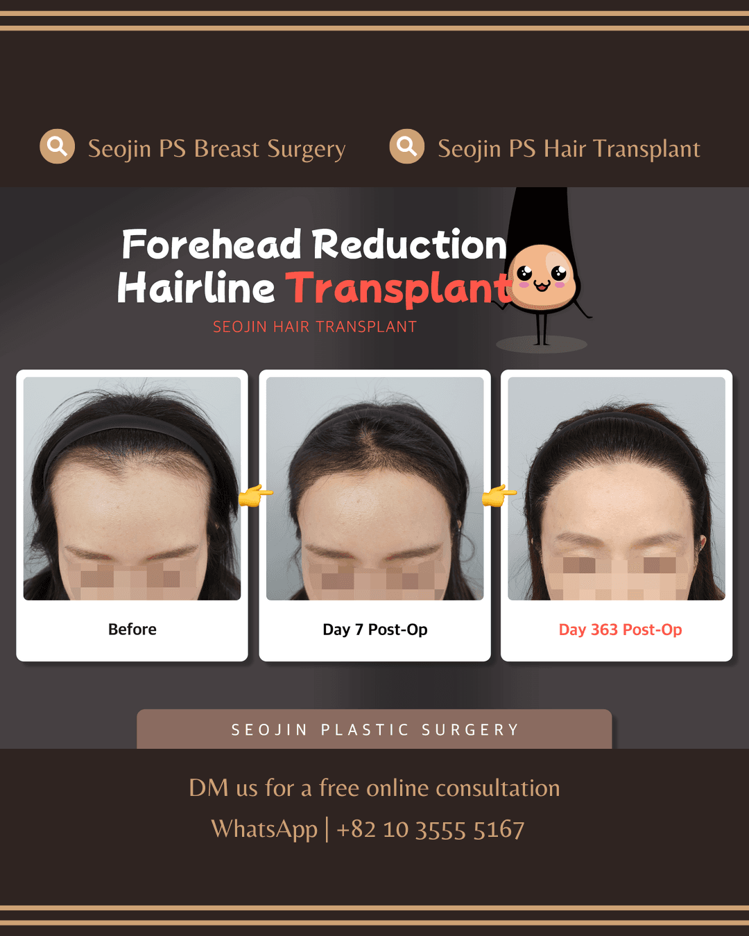 Hair Transplant, Forehead Reduction