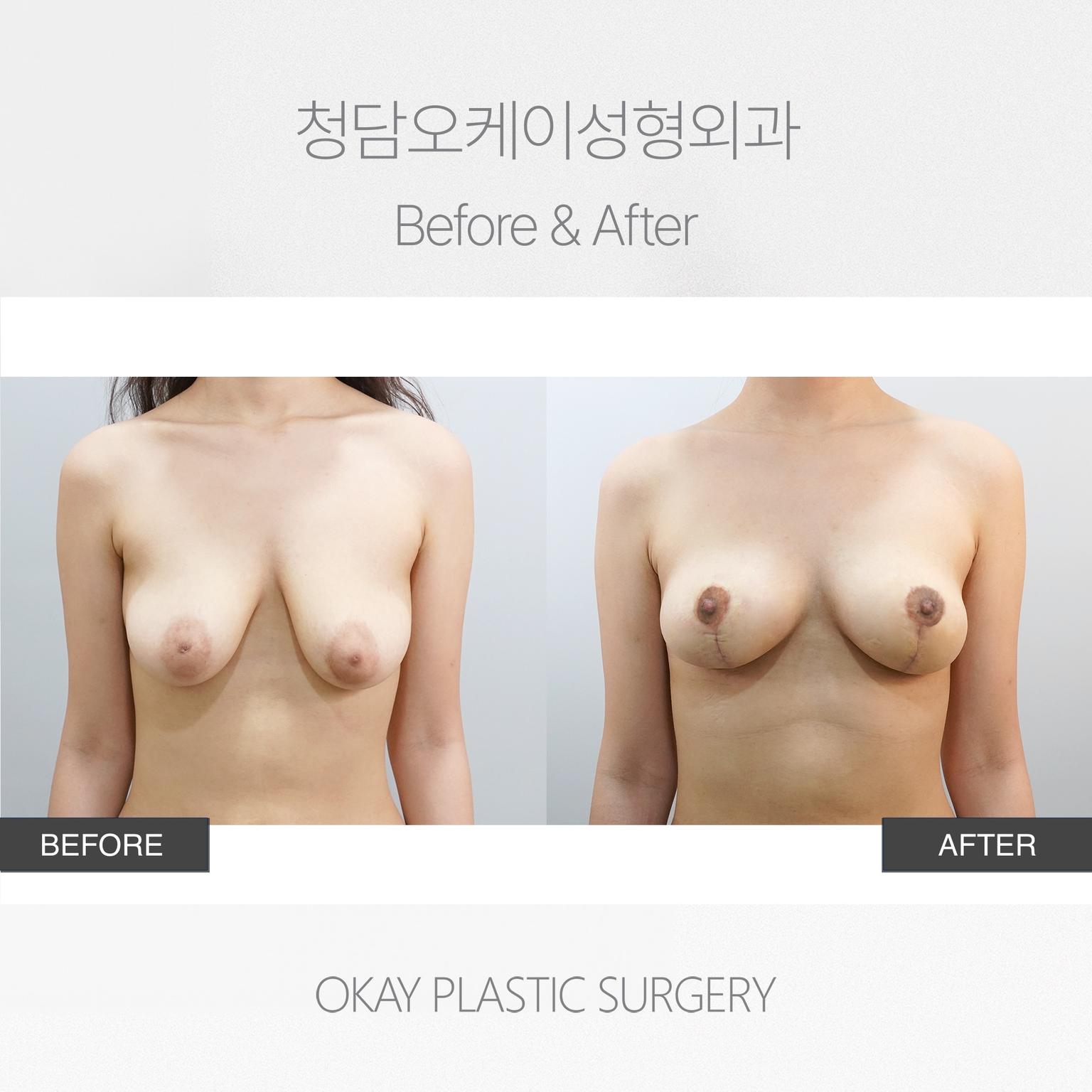 Breast Lift with Areolar Incision Method