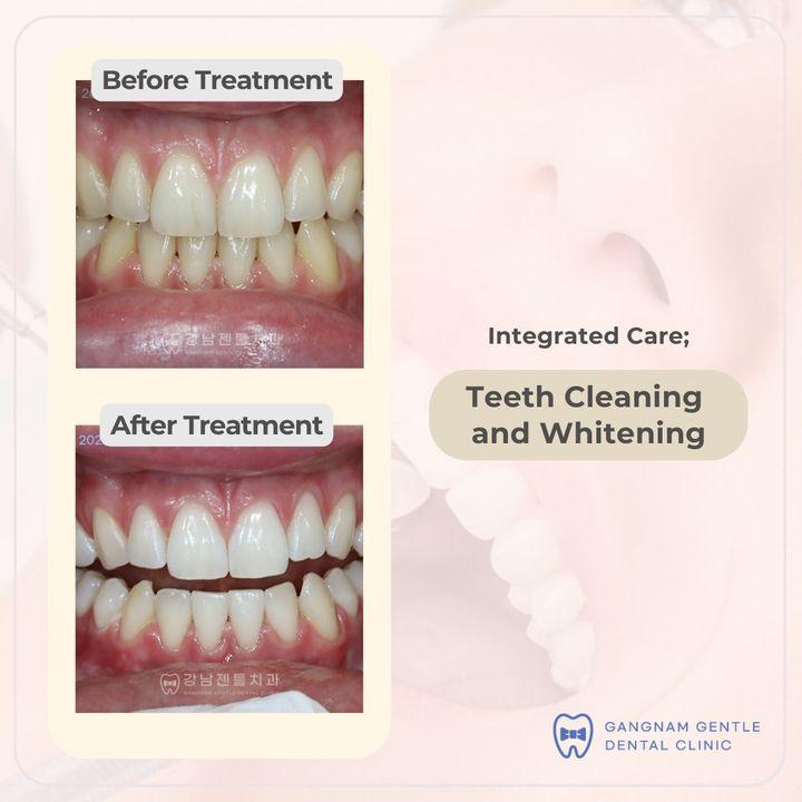Transform your smile with our professional teeth cleaning and whitening services. Brighten your teeth and boost your confidence with our expert dental care. Discover the power of a radiant smile at our clinic today.