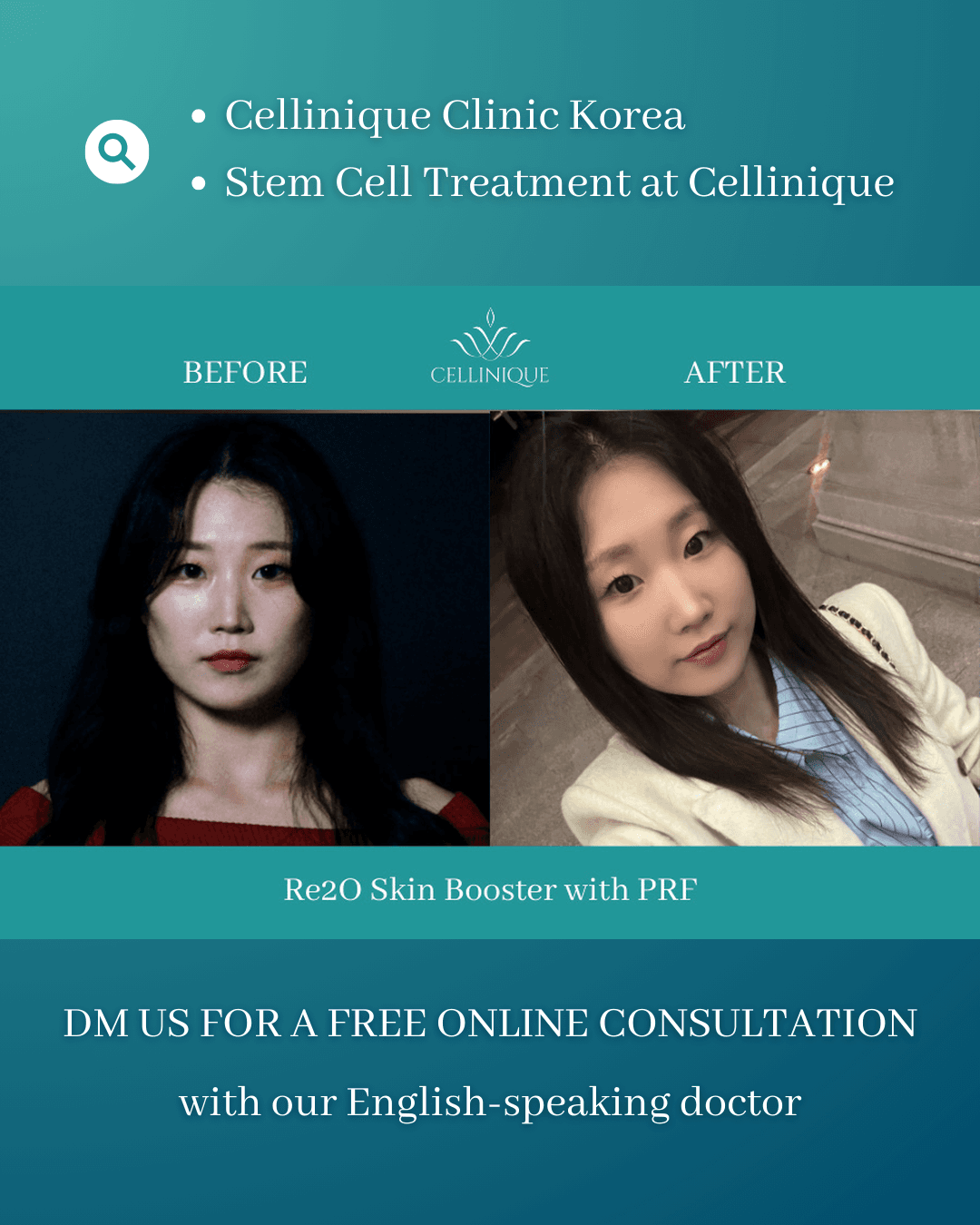 Re2O Skin Booster, PRF-Injektion, Skin Booster