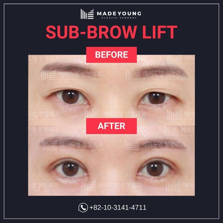 Elevate your beauty with a sub-brow lift. Our before and after photos capture the subtle yet stunning results.