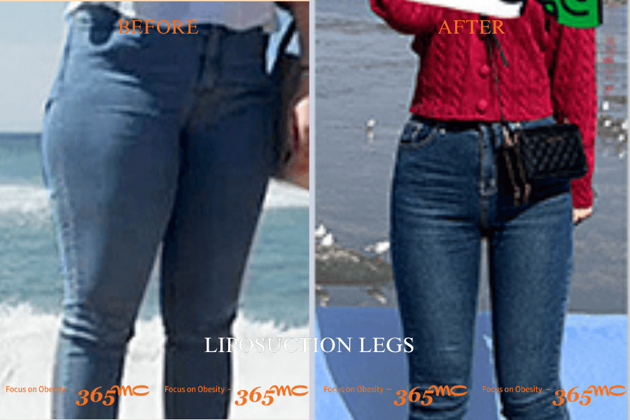 Before and After Calf Liposuction