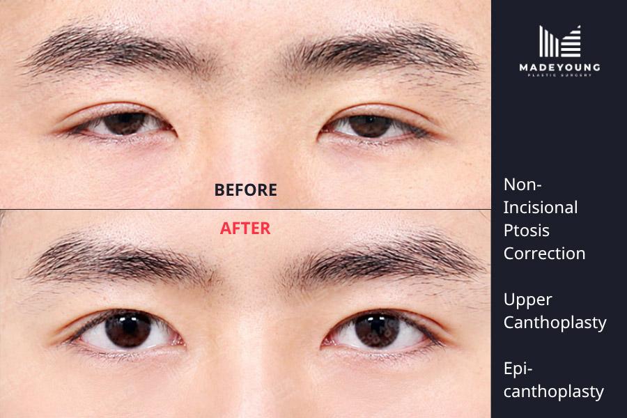 Incisional ptosis correction upper canthoplasty epicanthoplasty