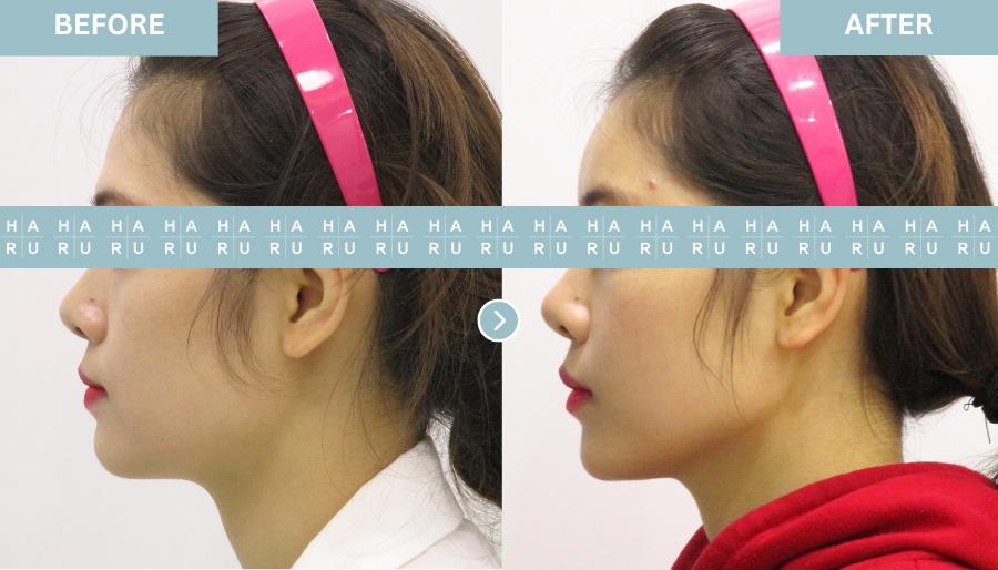 Thread Lift & Full Face Filler