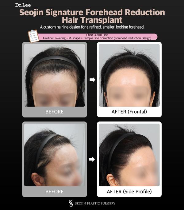 Before and After Hair Transplant