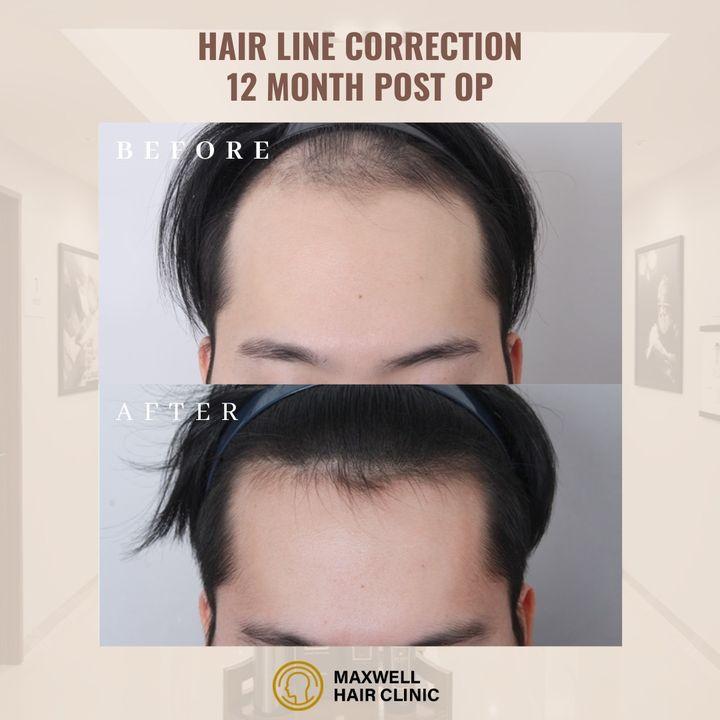 hairline correction korea