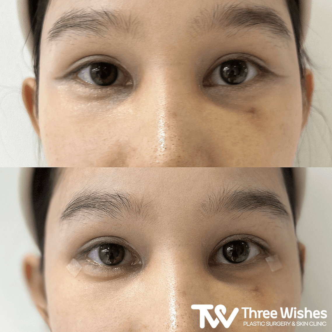 Before and After Under Eye Filler