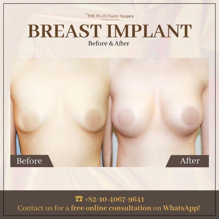 cost breast implant korea