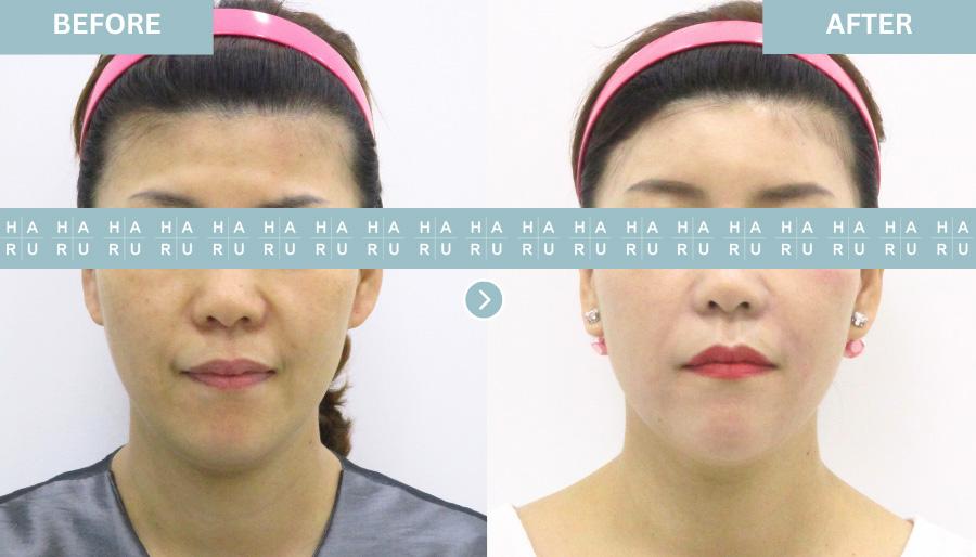 Forehead And Smile Line Filler