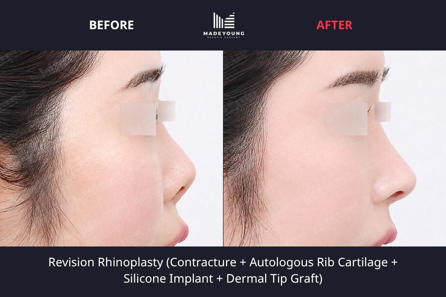 Rhinoplasty contracture autologous rib cartilage silicone implant dermal tip graft