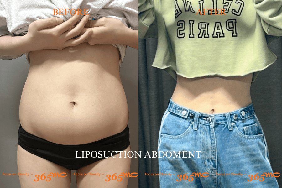 Before and After Abdominal Liposuction