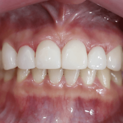 After Veneers