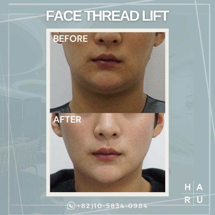 Elevate your natural beauty with our FACE Thread Lift. This cutting-edge procedure provides an immediate lifting effect while promoting long-term collagen production for a lasting youthful appearance. See the before and after, and let's discuss how this minimally invasive option can achieve your aesthetic goals.   🌈