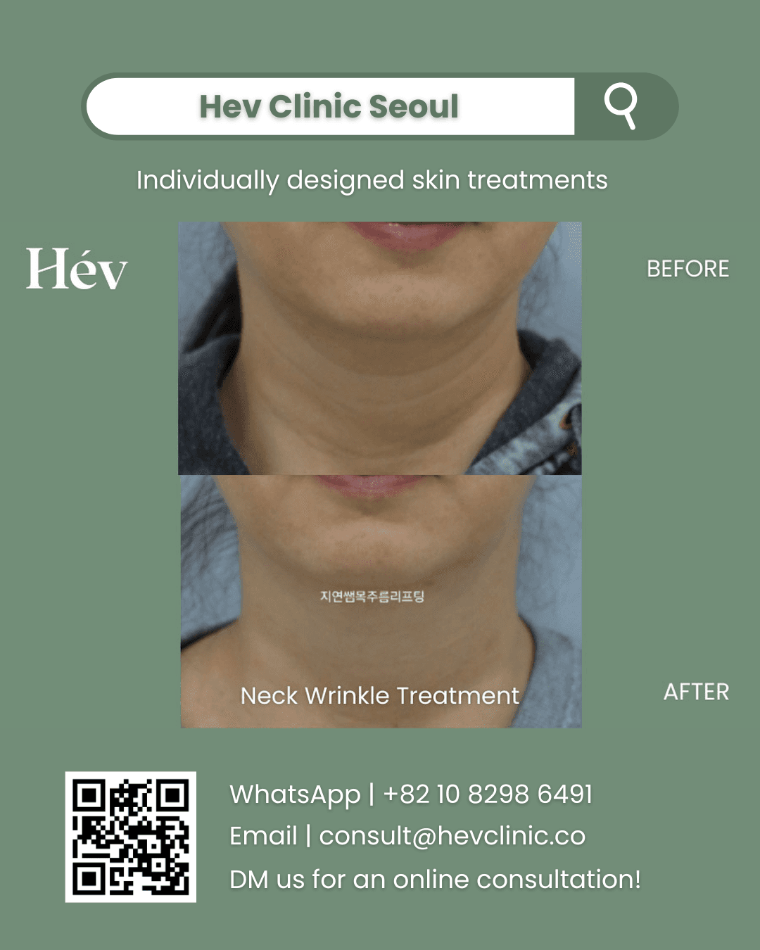 Neck Wrinkle Treatment