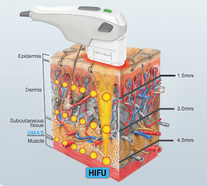HIFU laser