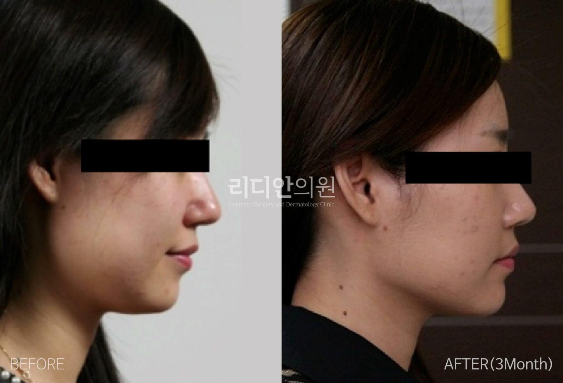 lydian-female-face-liposuction-01.jpg