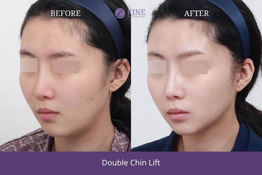 Double Chin lift