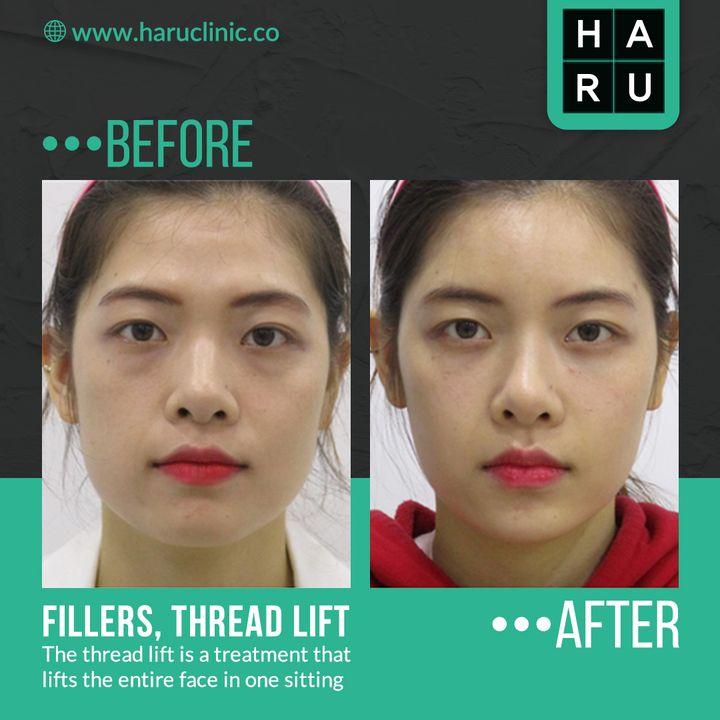 Haru Lifting is a unique thread lifting procedure that uses dissolvable threads. The result is a natural-looking lift with minimal bruising or swelling, allowing you to return to your daily life immediately after the procedure.  To make more presentable to others take treatment from Haru on Apple hip lifting.  🏥